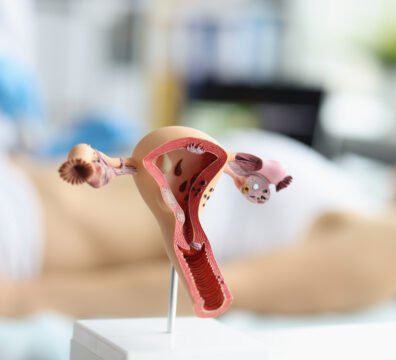 Υπερπλασία ενδομητρίου: Μπορεί να εξελιχθεί σε καρκίνο ενδομητρίου;